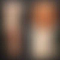 Sklerodermie zirkumskripte: Zusammenstellung klinischer Varianten des Kindes-und Jugendalters.&nb...