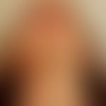 Parry-Romberg-Syndrom: Abbildung entnommen aus: Glaser DH et al. (2020)
