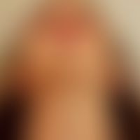 Parry-Romberg-Syndrom: Abbildung entnommen aus: Glaser DH et al. (2020)
