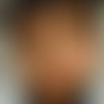 Parry-Romberg-Syndrom: Abbildung entnommen aus: Glaser DH et al. (2020)
