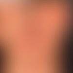Parry-Romberg-Syndrom&nbsp;als Teilmanifestation einer generalisierten zirkumskripten Sklerodermi...