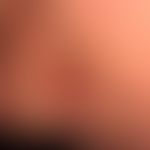 Melanom amelanotisches: seit längerem (?) bestehender rötlicher, seit einiger Ziet nässsender, je...