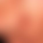 Melanom,&nbsp;amelanotisches: seit längerem (?) bestehender rötlicher, seit einiger Ziet nässsend...