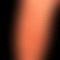 Blaschkitis: inflammatorische, lichenoide Dermatitis in typischer Anordnung in den Blaschko-Linie...