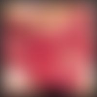 Differenzialdiagnose: Pemphigus vulgaris

Diagnose: Bednar`sche Aphthe&nbsp;
