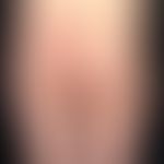 Sklerodermie zirkumskripte (bandförmige zirkumskripte Sklerodermie): Atrophie von Haut und subkut...
