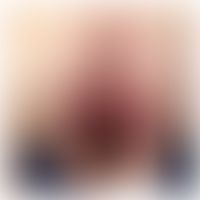 Dermatitis herpetiformis:&nbsp;flächenhafter erytheamtöse Plaques.&nbsp;Insgesamt besteht die Erk...