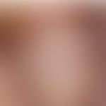 Erworbene Zwanzig-Nagel-Dystrophie:&nbsp;Erworbene Zwanzig-Nägel-Dystrophie;&nbsp; Nachweis einer...