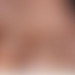 Erworbene Zwanzig-Nagel-Dystrophie:&nbsp;Erworbene Zwanzig-Nägel-Dystrophie;&nbsp; Nachweis einer...