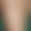 ​​​​​​Polymorphe und pruritische eosinophile Eruption bei Strahlentherapie: disseminierte rote, s...