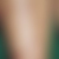 ​​​​​​Polymorphe und pruritische eosinophile Eruption bei Strahlentherapie: disseminierte rote, s...