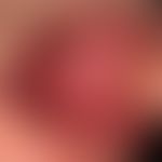 Leukoplakie orale:&nbsp;Morsicatio buccarum. Flächige, höckerige Schleimhautschwiele&nbsp;ohne je...