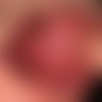 Leukoplakie orale:&nbsp;Morsicatio buccarum. Flächige, höckerige Schleimhautschwiele&nbsp;ohne je...