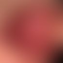 Morsicatio buccarum: flächenhafte Schleimhautschwiele&nbsp;durch Kauen der Schleimhäute.&nbsp;&nb...