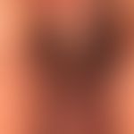 Condylomata acuminata: multiple, seit Monaten bestehende, nicht-symptomatische, weiche braune Kno...