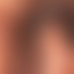 Condylomata acuminata: multiple, seit Monaten bestehende, nicht-symptomatische, weiche braune Kno...