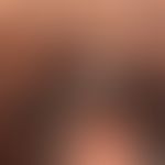Condylomata acuminata: multiple, seit Monaten bestehende, nicht-symptomatische, weiche braune Kno...