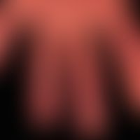 Differenzialdiagnose: Dyshidrosis lamellosa sicca&nbsp;

Diagnose: Hand-Fuß-Syndrom
