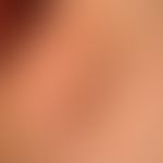 Lymphknotenmetastase: metastasiertes malignes Melanom, Rezidiv einer Lymphknotenmetastase.&nbsp;
