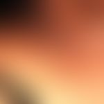 Acanthosis nigricans: schwarzbraune, papillomatös-hyperkeratotische, flächenhafte, unscharf begre...