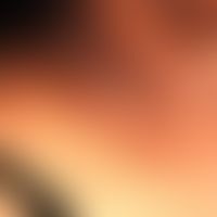 Acanthosis nigricans: schwarzbraune, papillomatös-hyperkeratotische, flächenhafte, unscharf begre...