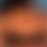 Acanthosis nigricans (benigna): generalisiertes Krankheitsbild mit großflächigen, unscharf begren...
