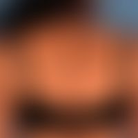 Acanthosis nigricans (benigna): generalisiertes Krankheitsbild mit großflächigen, unscharf begren...