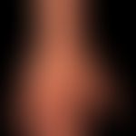 Mycobacterium marinum/Mykobakteriose, nichtuberkulöse:&nbsp;seit 12 Wochen bestehender, unscharf ...