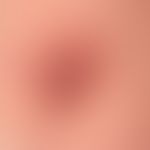 Mycobacterium marinum/Mykobakteriose, nichtuberkulöse:&nbsp;Untypische lokalisierter, schmerzlose...