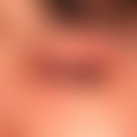 Differenzialdiagnose: Liddermatitis

Diagnose: Psoriasis (guttata-Typ); wenig infiltrierte, unsch...