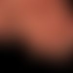 Pachyonychia congenita: alle Finger- und Zehennägel betreffende, angeborene Nageldystrophie mit P...