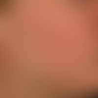 Keratosis pilaris (follicularis):&nbsp;follikelgebundene, spitzkegelige Hornpfröpfe der Wangenreg...
