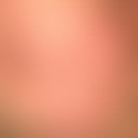 Keratosis pilaris (follicularis):&nbsp;follikelgebundene, rote, keratotische Papeln der Wangenreg...