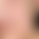 Epidermalzyste: seit&nbsp;Jahren bekannter schmerzloser Knoten. Nebenbefundlich: Lippenrandangiom
