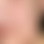 Lippenrandangiom der Unterlippe:&nbsp;nebenbefundlich: Epidermalzyste der linken Wange.
