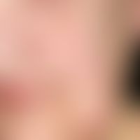 Lippenrandangiom der Unterlippe:&nbsp;nebenbefundlich: Epidermalzyste der linken Wange.
