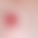 Hämangiom des Säuglings: gemischtes (intra-/subkutanes) Hämangiom
