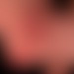 Hämangiomatose&nbsp;des Säuglings: (s.a.folgende Abbildungen); rote unregelmäßige Plaque mit zent...