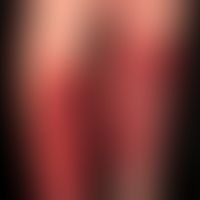 Kontaktdermatitis toxische: schwere toxische Reaktion mit blasiger Abhebung.
