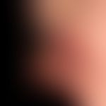 Karzinom kutanes:&nbsp;fortgeschrittenes, ulzeriertes exophytisches Plattenpithelkarzinom .
