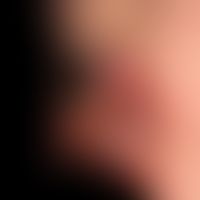 Karzinom kutanes:&nbsp;fortgeschrittenes, ulzeriertes exophytisches Plattenpithelkarzinom .
