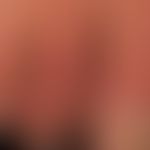 Schwiele: Clavus über dem Mittelgelenk der 2. Zehe
