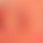 Basalzellkarzinom sklerodermiformes: schwierig abgrenzbares kaum palpables Basalzellkarzinom, erk...