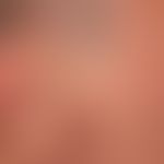 Basalzellkarzinom sklerodermiformes: schwierig abgrenzbares kaum palpables Basalzellkarzinom, erk...