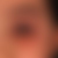 Dermatitis, atopische: chronische, rezidivierende Liddermatitis bei generalisierter atopischer De...