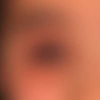 Dermatitis, atopische: chronische, rezidivierende Liddermatitis bei generalisierter atopischer De...