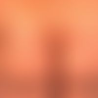 Dermatitis, atopische: chronische, juckende Plaques mit Schuppungen und&nbsp;Erosionen&nbsp;&nbsp...