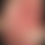 Pemphigoid, bullöses. Übersichtsaufnahme: Maximal exazerbiertes Krankheitsbild an Stamm und Extre...