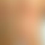 Erythema anulare centrifugum: rezidivierende kaum schuppende, zentrifugal wandernde Plaques. Abb....
