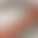Erythema papulatum centrifugum: flächiges kleinpapulöses Exanthem mit anulären Formationen. Zugru...
